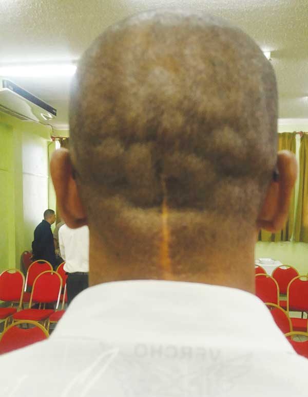 Image of Colin Weekes' scar