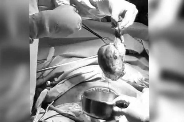Patient with Laparoscopic Surgery at VH 17th October 2018