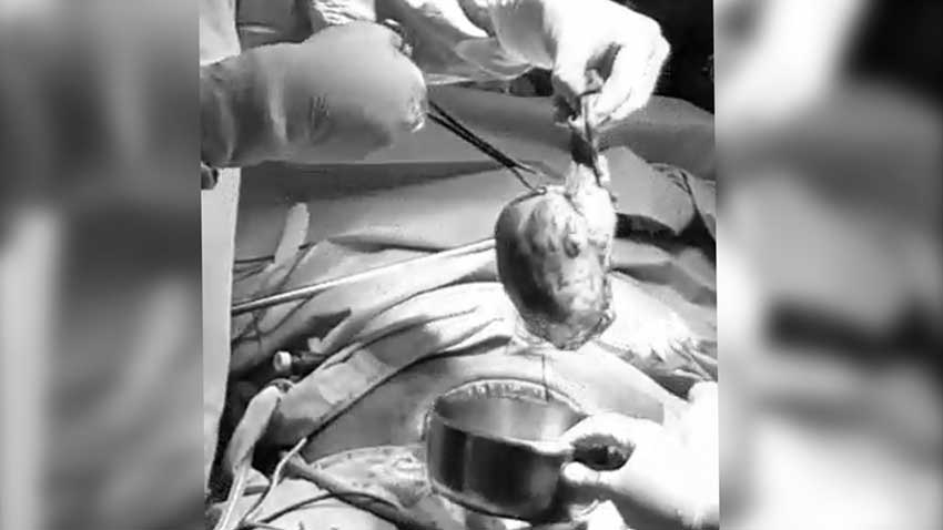 Patient with Laparoscopic Surgery at VH 17th October 2018